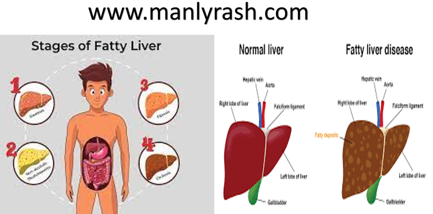 Fatty Liver Symptoms