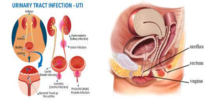 Urine Infection or Urinary Tract Infection