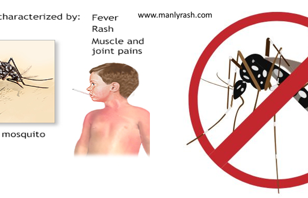 dengue fever florida
