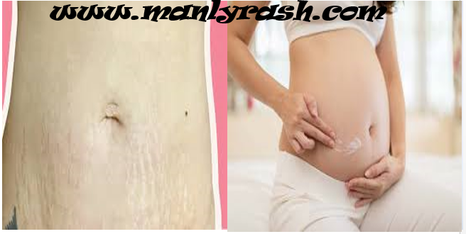 Stretch marks or stretch marks during pregnancy
