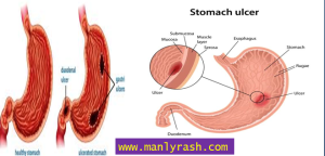 Signs of stomach ulcer